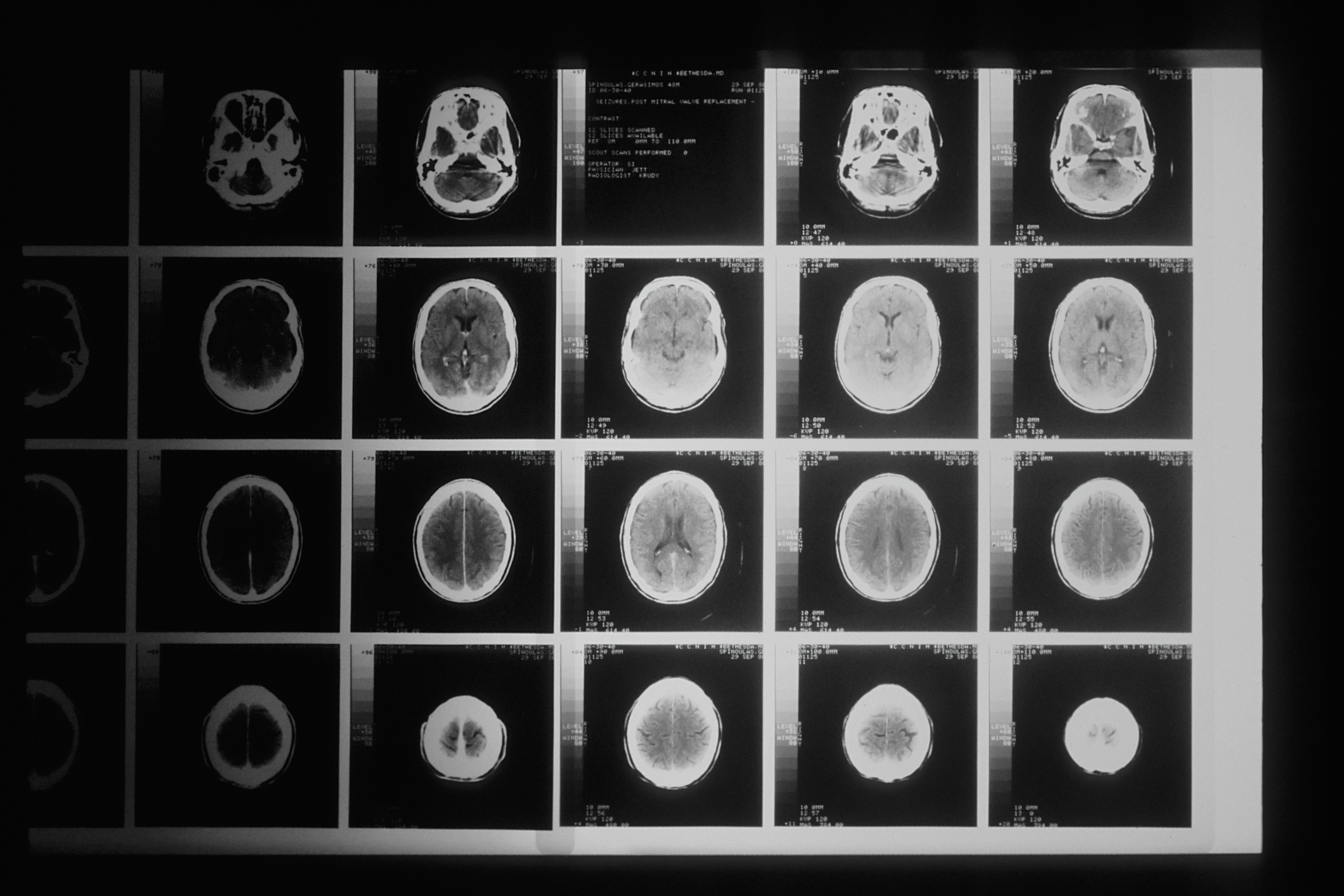 A head x-ray taken by a computer-assisted tomographic (CAT) scanner. This diagnostic technique uses computers to organize thousands of x-rays, taken by a rotating machine around the patient. Brain injury accident theme.