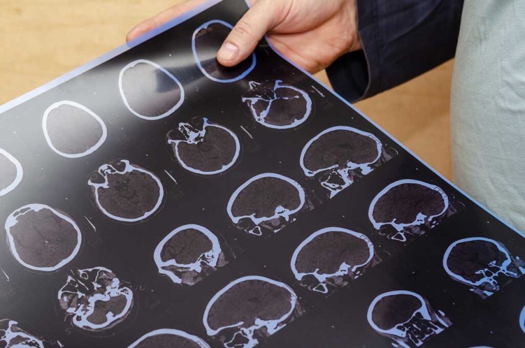 person holding images of a brain scan, brain injury theme