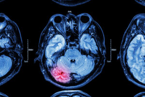 MRI of brain : brain injury in the left lobe