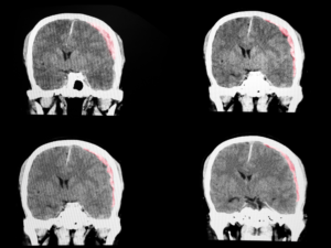 black and white brain scan with red to indicate injury