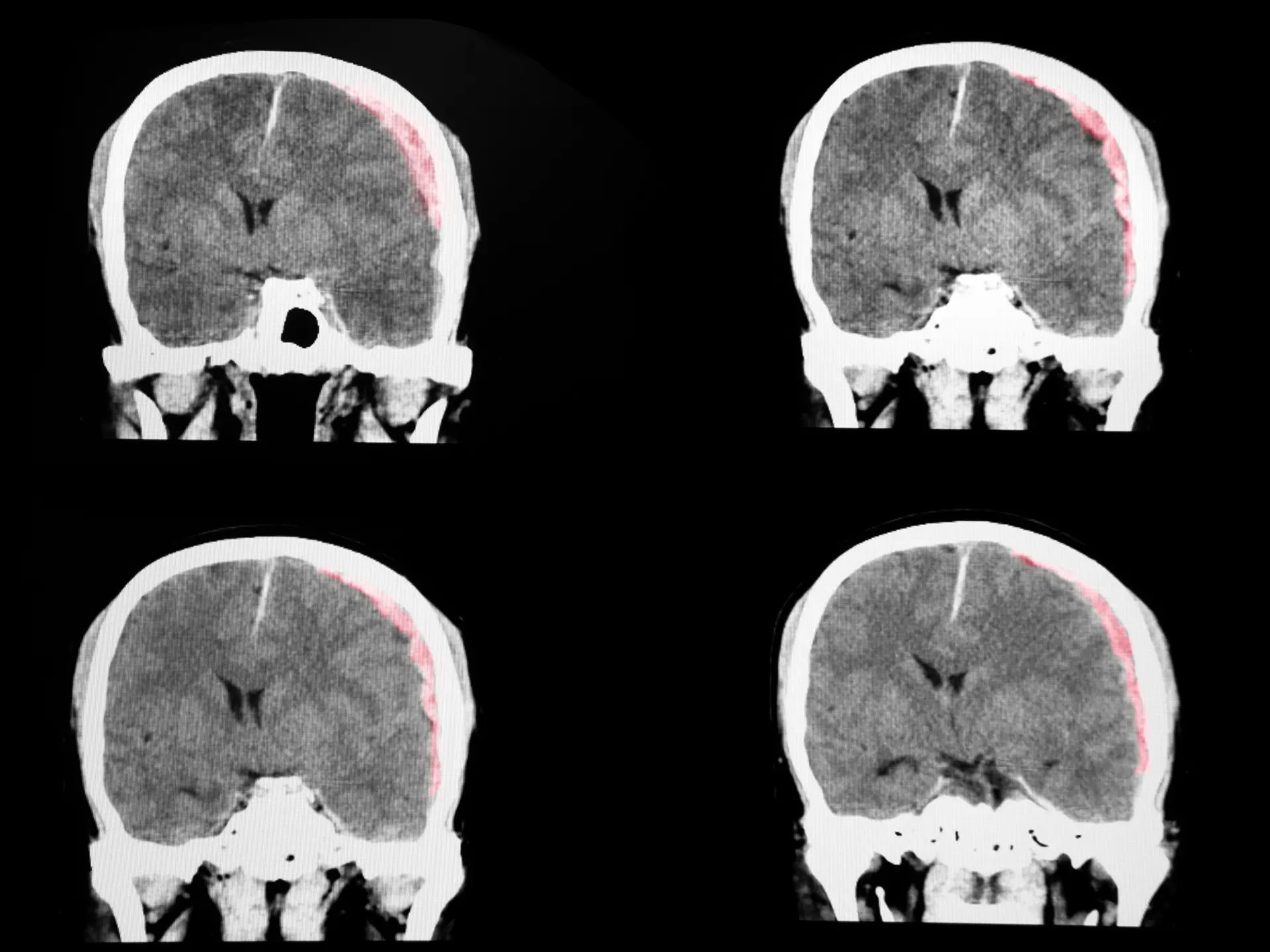 black and white brain scan with red to indicate injury